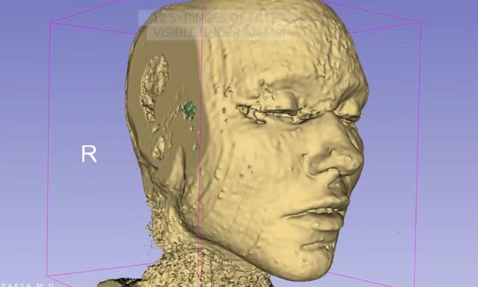 fileri, magnetna rezonanca
