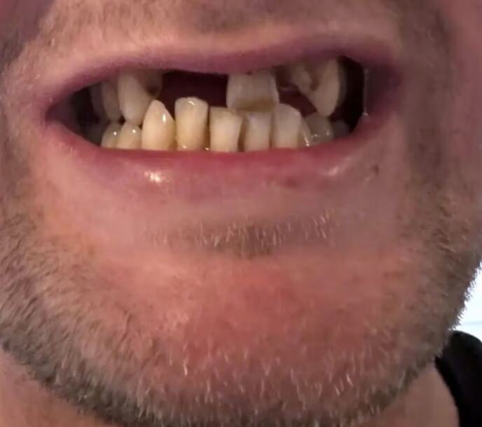 Džon Denton ostao bez zuba u Turskoj (7).png